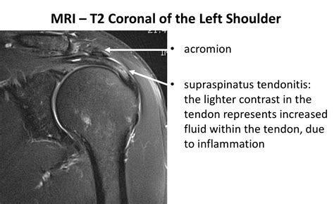 rotator cuff tendinitis mri